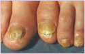 infection des ongles